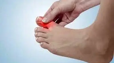 علت ابتلای  انگشتان پا به التهاب مفصلی چیست؟