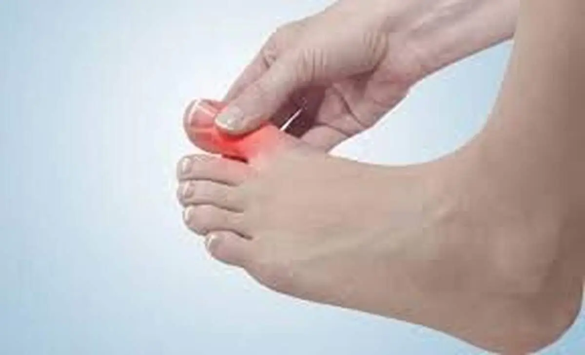 علت ابتلای  انگشتان پا به التهاب مفصلی چیست؟