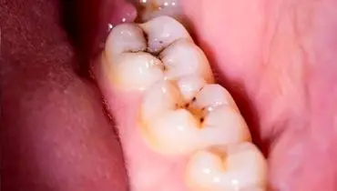 کشف راز پوسیدگی دندان/ ژنتیک در سلامت دهان و دندان تاثیر دارد؟
