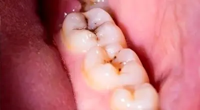 کشف راز پوسیدگی دندان/ ژنتیک در سلامت دهان و دندان تاثیر دارد؟
