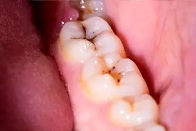 کشف راز پوسیدگی دندان/ ژنتیک در سلامت دهان و دندان تاثیر دارد؟
