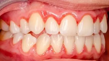 افزایش خطر این نوع سکته با بیماری لثه