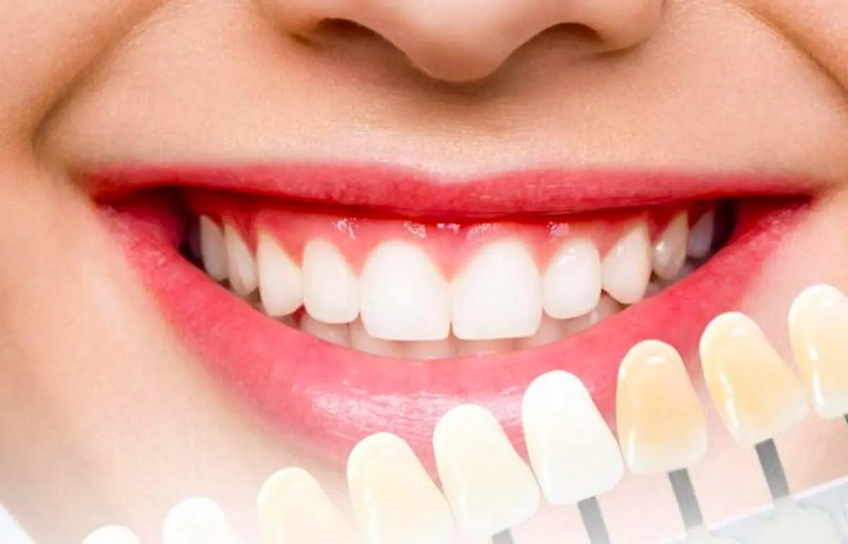 رازی که رنگ دندان فاش میکند؛ خطرناک ترین لکه چه رنگی است؟