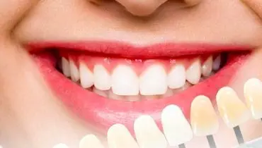 رازی که رنگ دندان فاش میکند؛ خطرناک ترین لکه چه رنگی است؟