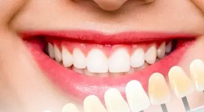 رازی که رنگ دندان فاش میکند؛ خطرناک ترین لکه چه رنگی است؟