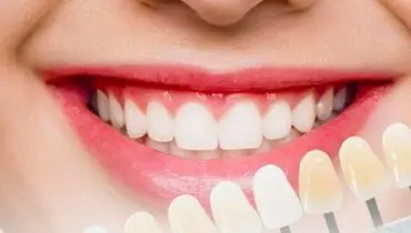 رازی که رنگ دندان فاش میکند؛ خطرناک ترین لکه چه رنگی است؟