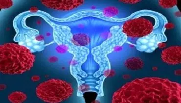 دانستنی هایی درباره فیبروم رحمی
