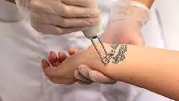 راه پاک کردن خالکوبی و تاتو در خانه چیست؟
