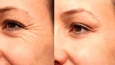 ترفندهای سه‌گانه برای کاهش چین و چروک دور چشم قبل از عید