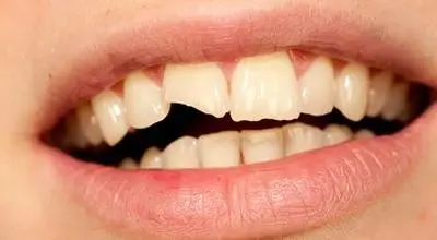 چرا دندان‌ها زود به زود پوسیده می‌شوند؟