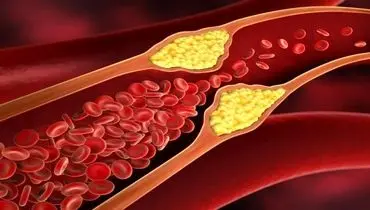 چرا باید چربی خون را جدی بگیریم؟