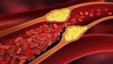 چرا باید چربی خون را جدی بگیریم؟