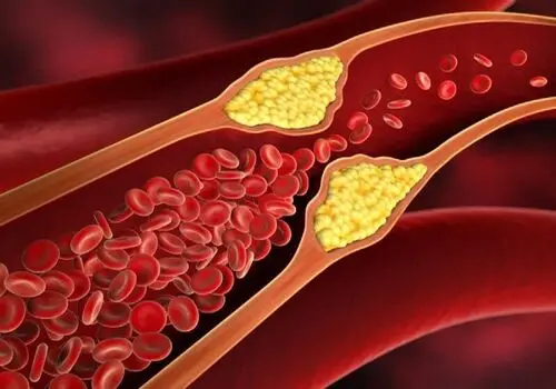 چربی خون بالا و غذاهایی که نباید خورد
