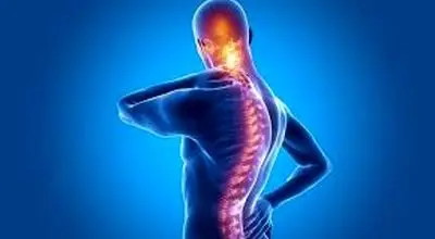 علائم و درمان روماتیسم ستون فقرات یا آرتریت روماتوئید