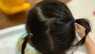  دلایل سفید شدن مو در کودکان