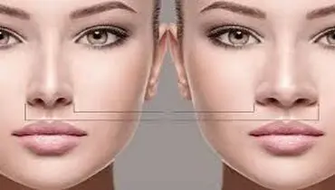 آیا جراحی بینی گوشتی برگشت پذیر است؟
