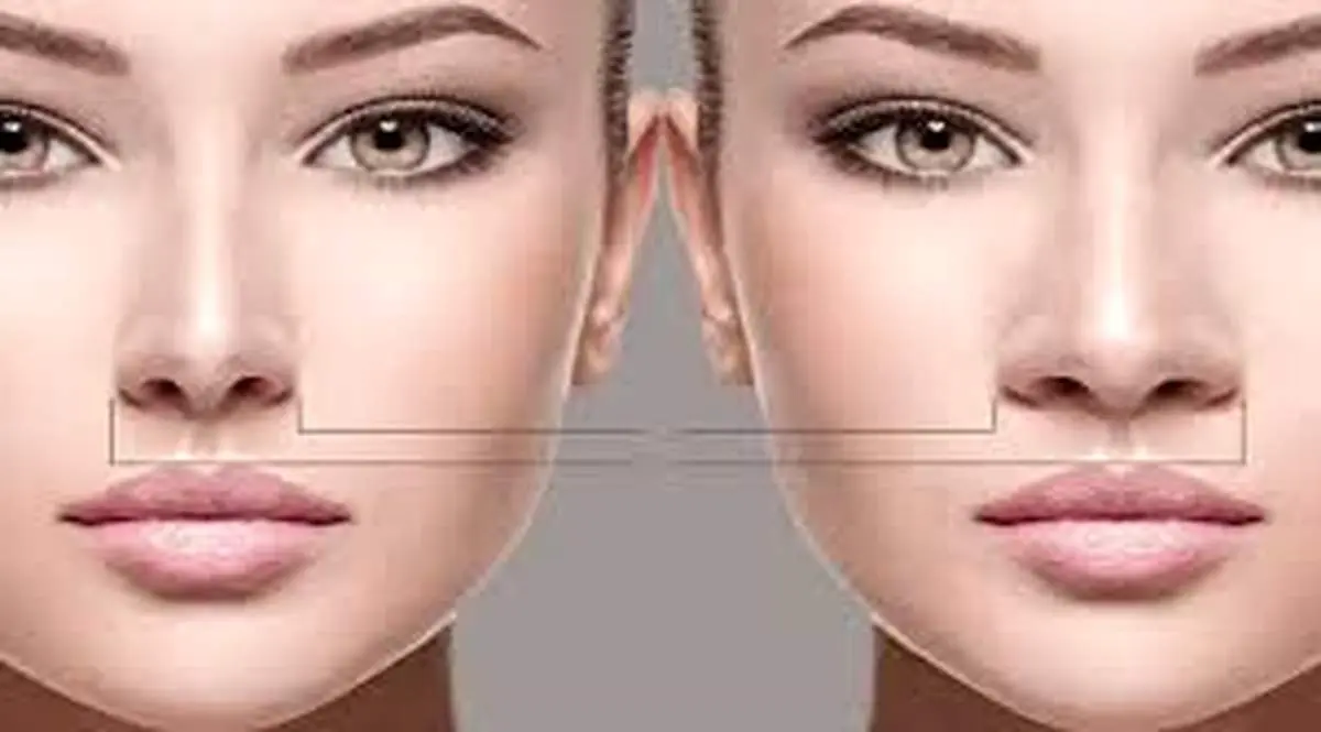 آیا جراحی بینی گوشتی برگشت پذیر است؟
