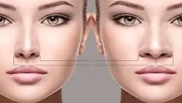 آیا جراحی بینی گوشتی برگشت پذیر است؟
