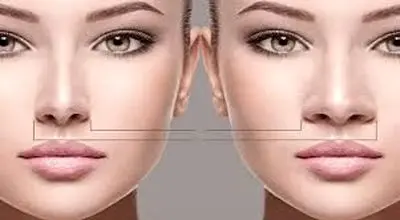 آیا جراحی بینی گوشتی برگشت پذیر است؟
