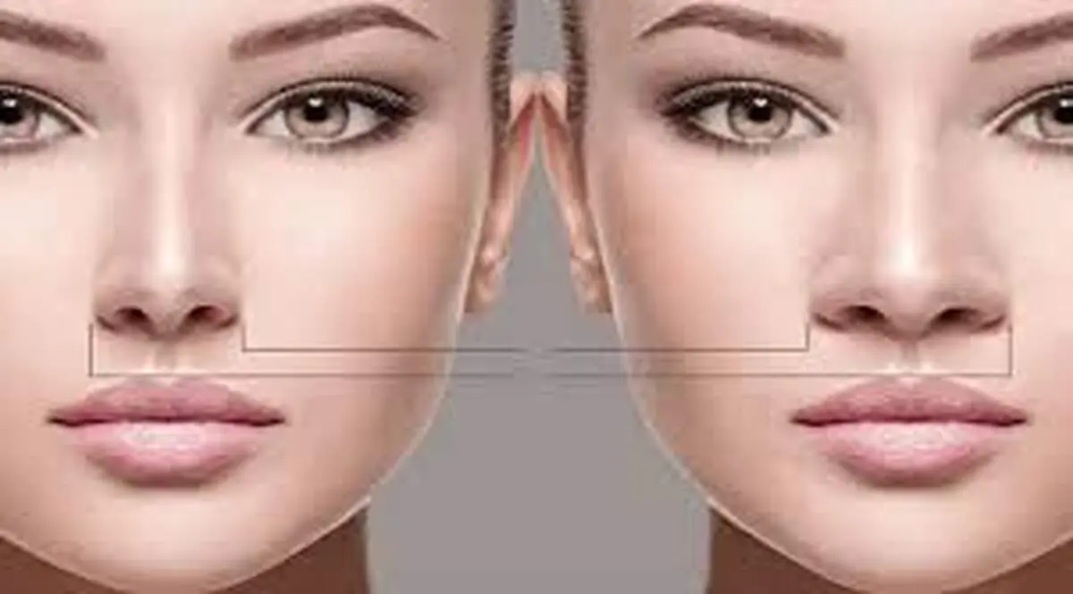 آیا جراحی بینی گوشتی برگشت پذیر است؟
