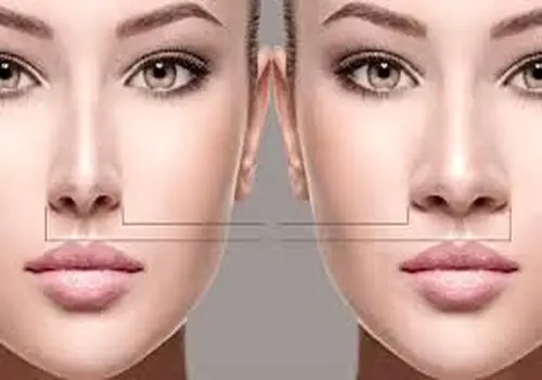 آیا جراحی بینی گوشتی برگشت پذیر است؟
