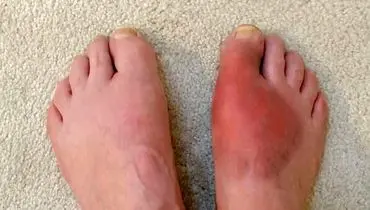 کشف مرحله «خاموش» آرتریت روماتوئید
