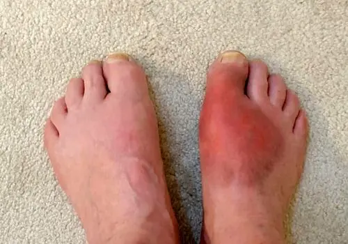 کشف مرحله «خاموش» آرتریت روماتوئید
