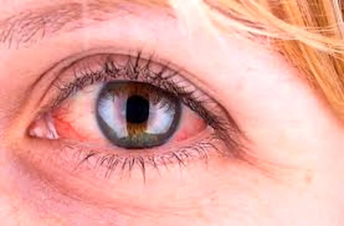 دلایل قرمز شدن چشم
