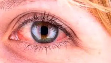 دلایل قرمز شدن چشم

