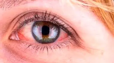 دلایل قرمز شدن چشم
