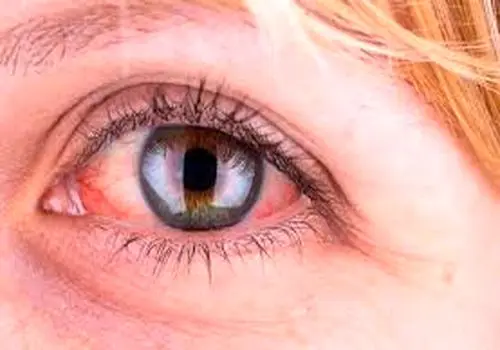 دلایل قرمز شدن چشم
