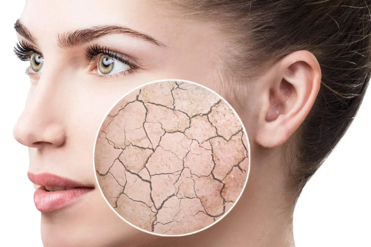 اگر این مواد را مصرف می‌کنید خشکی پوست در کمین شماست