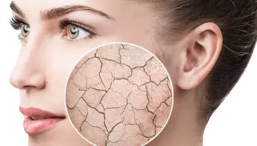 اگر این مواد را مصرف می‌کنید خشکی پوست در کمین شماست