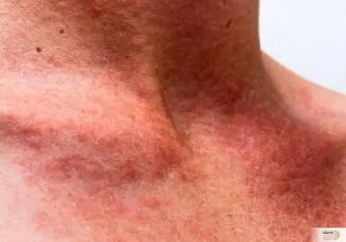 جلوگیری از آفتاب‌سوختگی در پیاده‌روی اربعین

