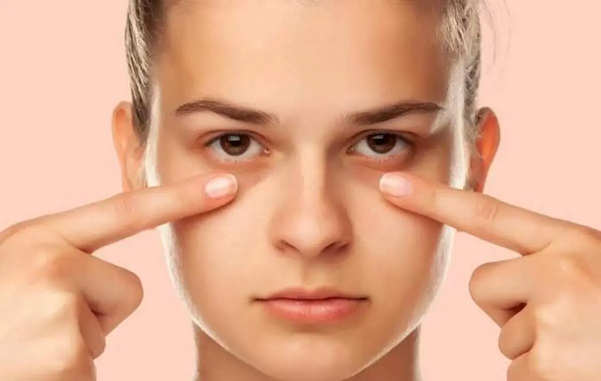 چند راهکار فوری برای رفع پف زیر چشم