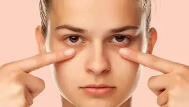 چند راهکار فوری برای رفع پف زیر چشم