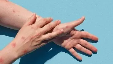 چرا آبله مرغان در بهار شایع‌تر می‌شود؟ (3 دلیل اصلی)