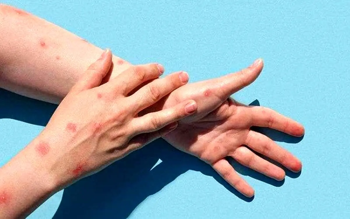 چرا آبله مرغان در بهار شایعتر میشود؟ (3 دلیل اصلی)