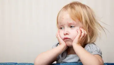 آبله مرغان تا چند روز واگیر دارد ؟
