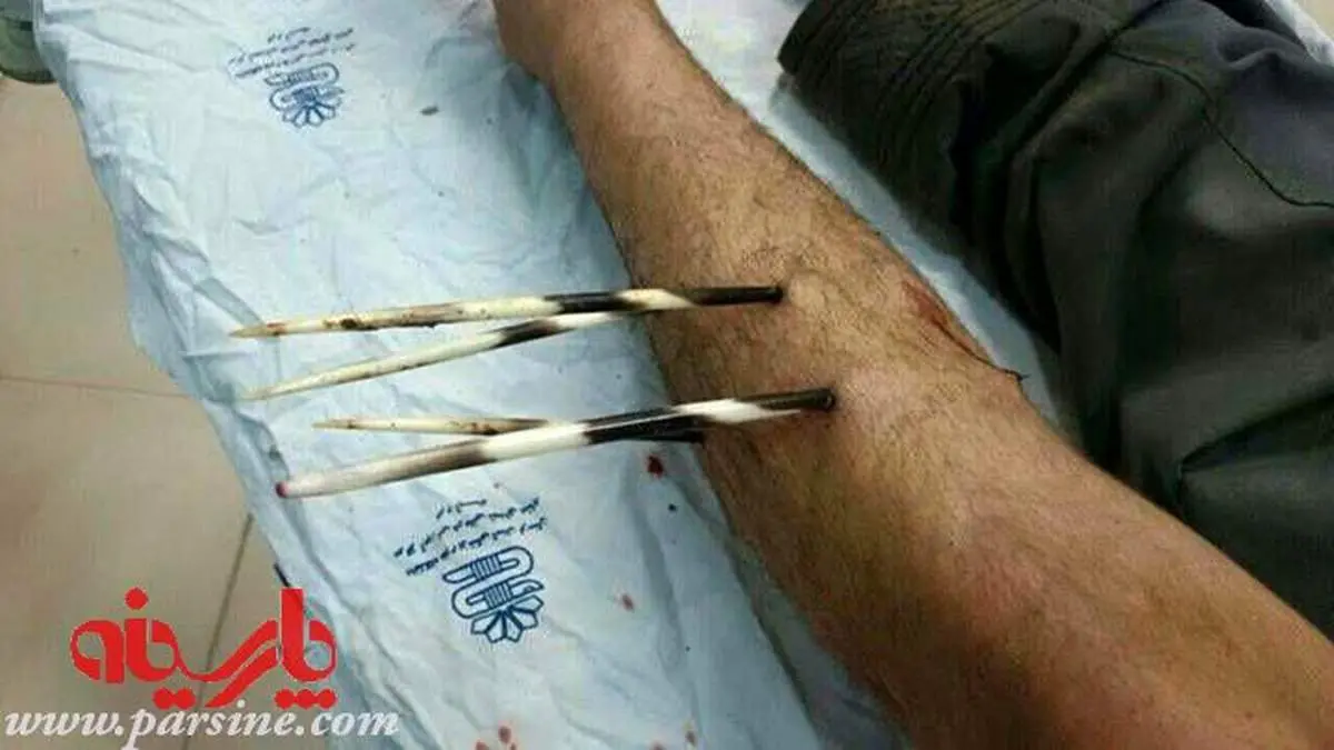 حمله جوجه تیغی به کشاورز/خرم آباد