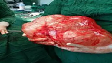 خروج توده 12 کیلویی از شکم بیمار