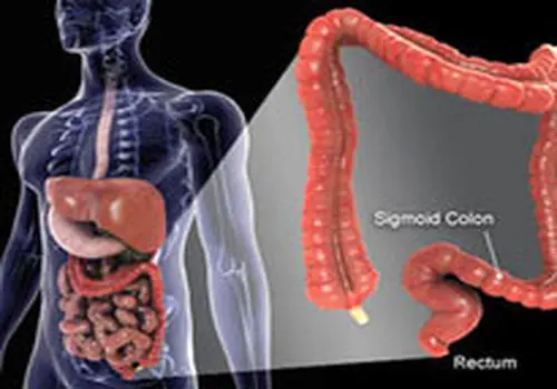 ۵ علامت هشداردهنده سرطان معده که باید بدانید