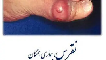 غذاهايی که مانع بروز نقرس می شود