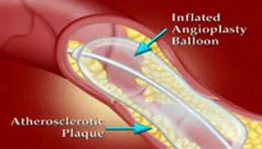 چه افرادی به آنژیوپلاستی نیاز دارند؟