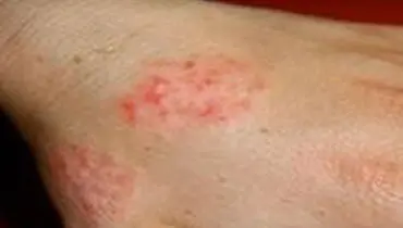 نقش سروتونین در ابتلا به اگزما