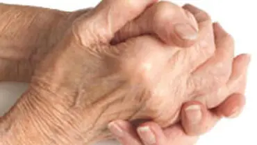 جانشین داروهای آرتروز