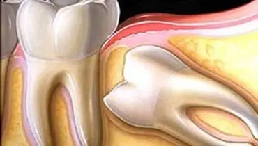 با لیزر رنگ دندانهایتان را عوض کنید