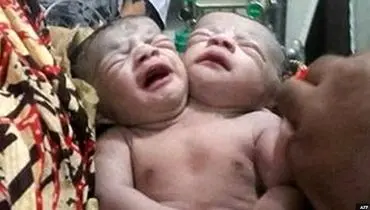 تولد نوزادی با 2 سر در بنگلادش + عکس