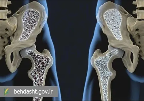 چه کسانی بیشتر به پوکی استخوان مبتلا می‌شوند؟
