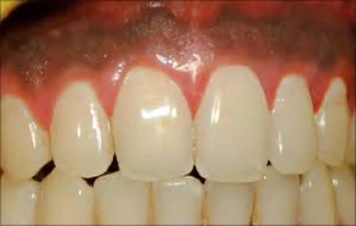 سیاه شدن لثه بعد از ایمپلنت: علل، پیشگیری و درمان
